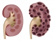 Открыт новый механизм поликистоза почек