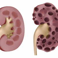 Открыт новый механизм поликистоза почек