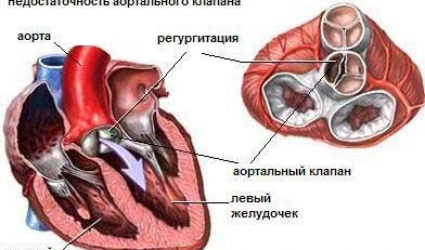 Аортальная недостаточность