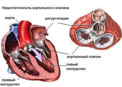 Аортальная недостаточность