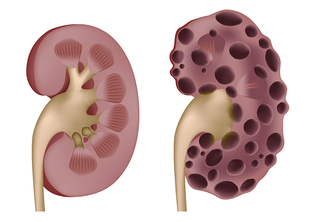 Открыт новый механизм поликистоза почек